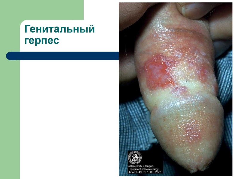 Генитальный герпес